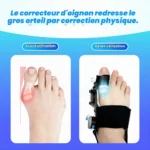 Correcteur Pour Gros Orteil – Avec Séparateur D’orteils En Silicone – Réglable et Doté De Coussinets Confortables – Image 5